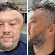 Neil Danziger before and after an operation to remove a brain tumour