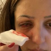 Shereen-Fay Griffin lost sight in her left eye due to a flesh eating parasite